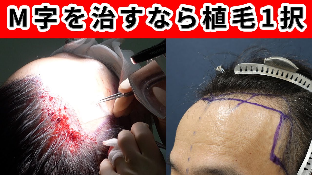 【必見】生え際やM字のコンプレックスを効果的に治します！