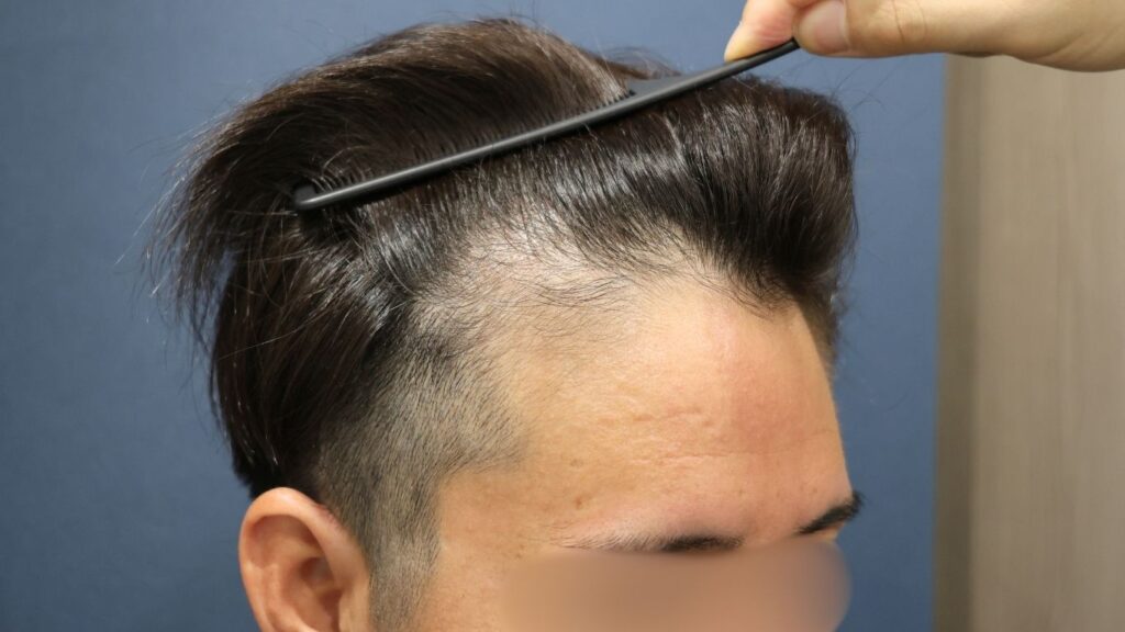 【植毛 症例更新】30代男性｜生え際の薄毛1500グラフト