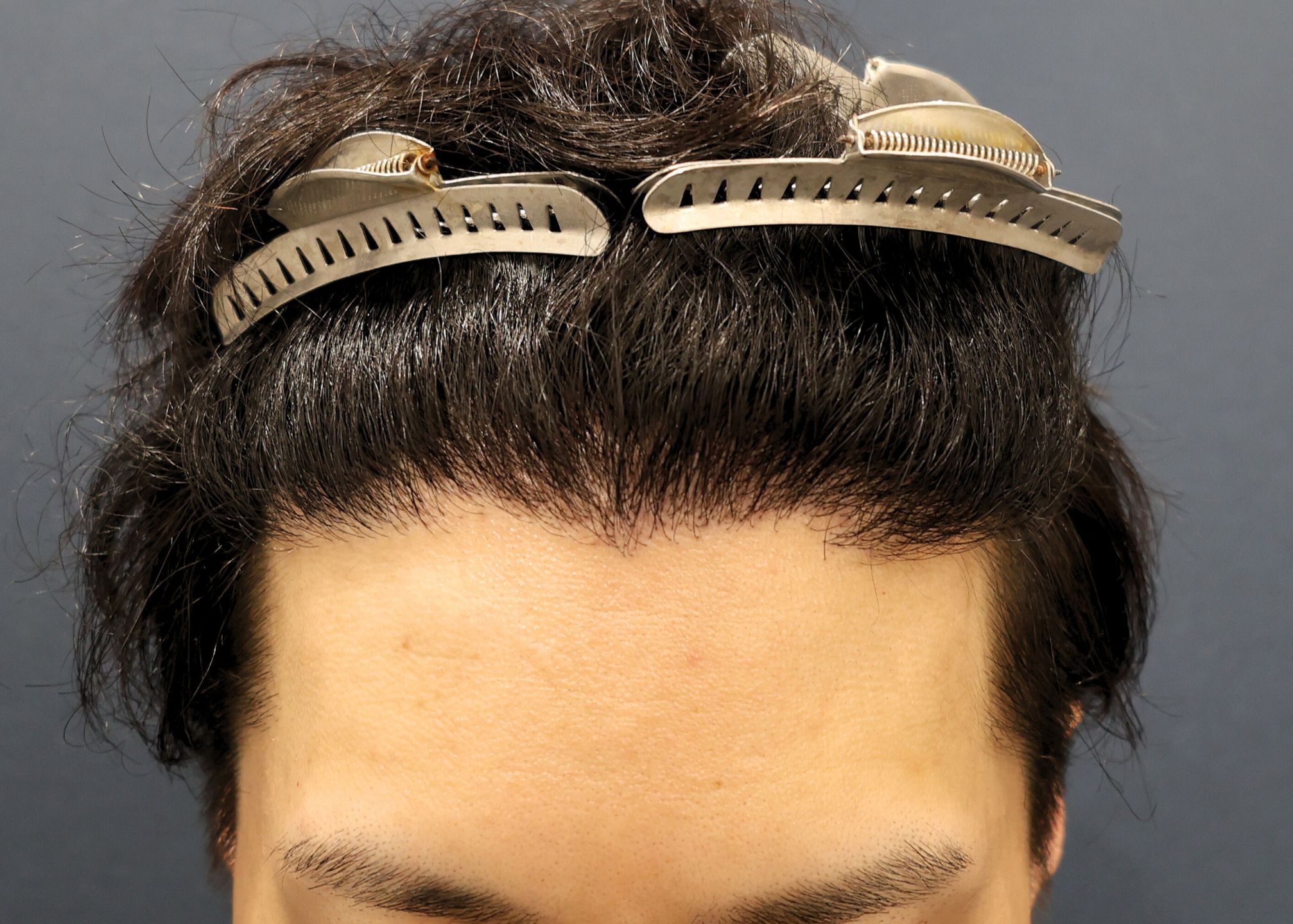 【2回目】術後1年