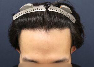 術後1年
