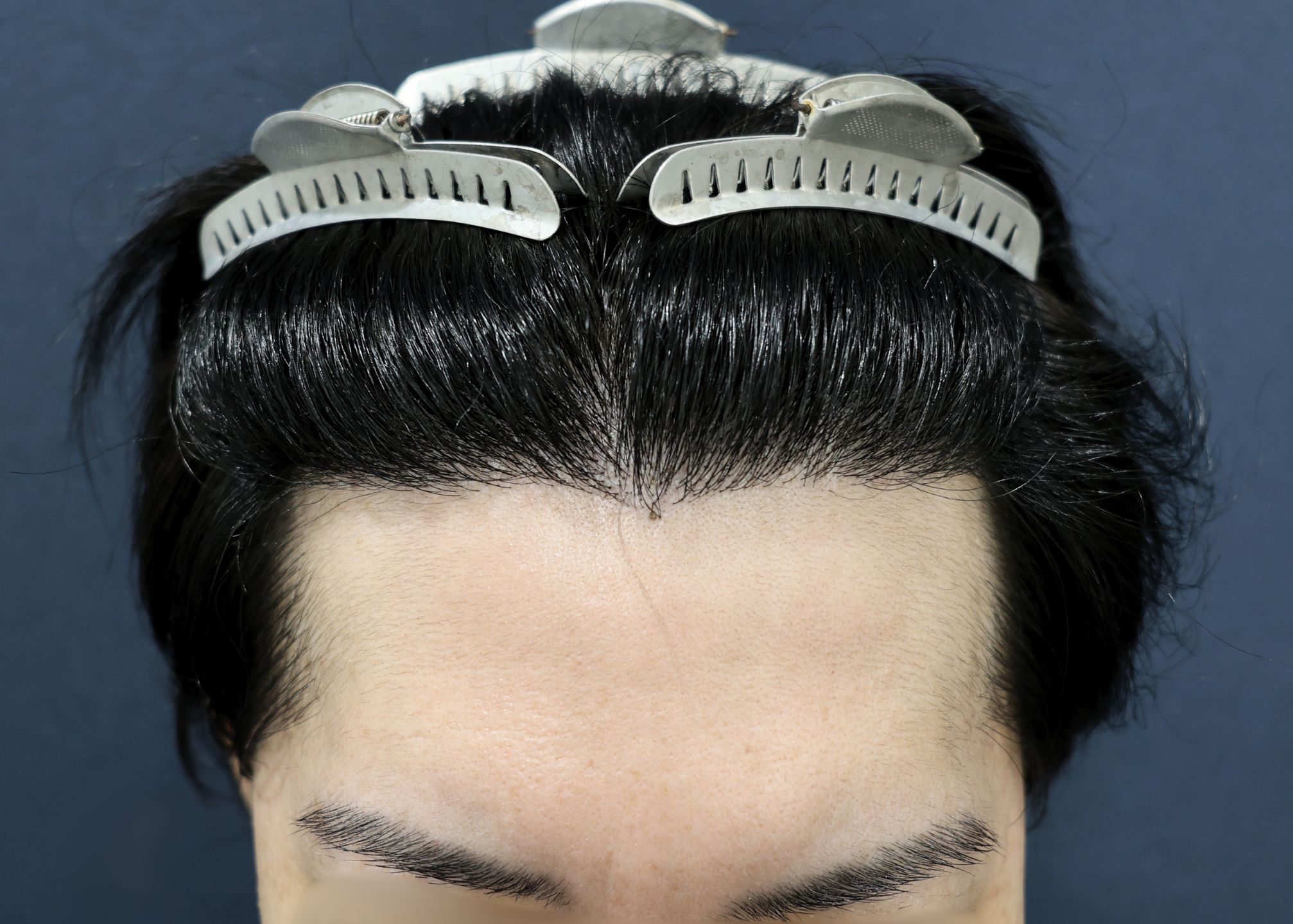 【2回目】術後6ヶ月