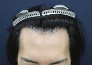 【1回目】施術前