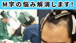 【悩み解決】気になるM字を植毛で治す手術をお見せします！！