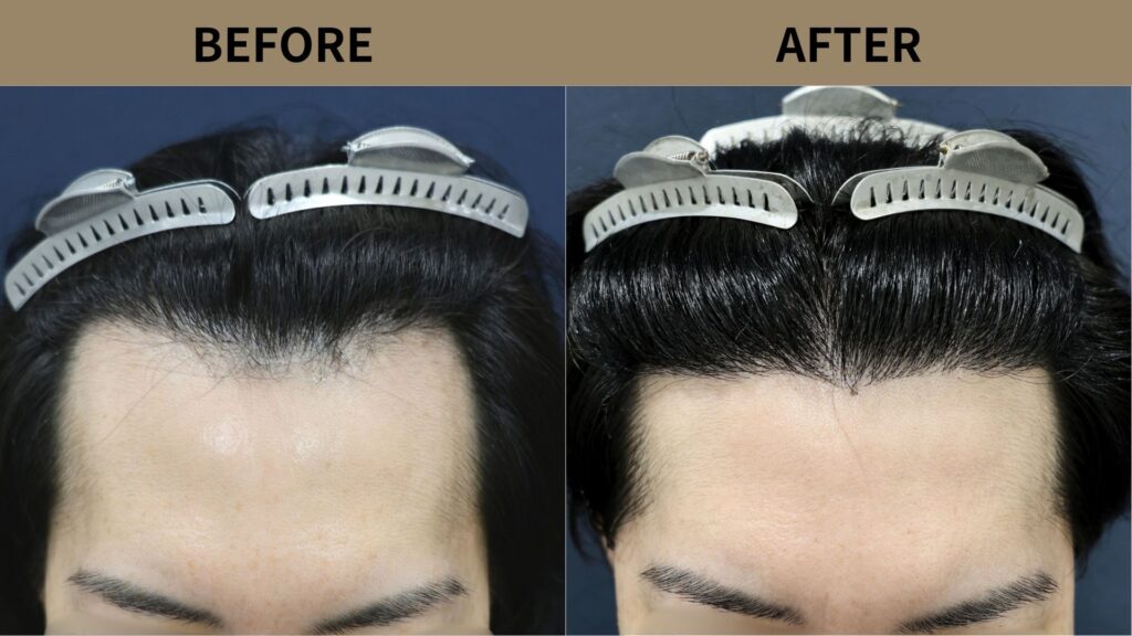 【症例更新】40代男性｜生え際の薄毛・他院修正・当院2回目