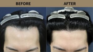 【植毛 症例更新】40代男性｜生え際の薄毛・他院修正・当院2回目1200グラフト