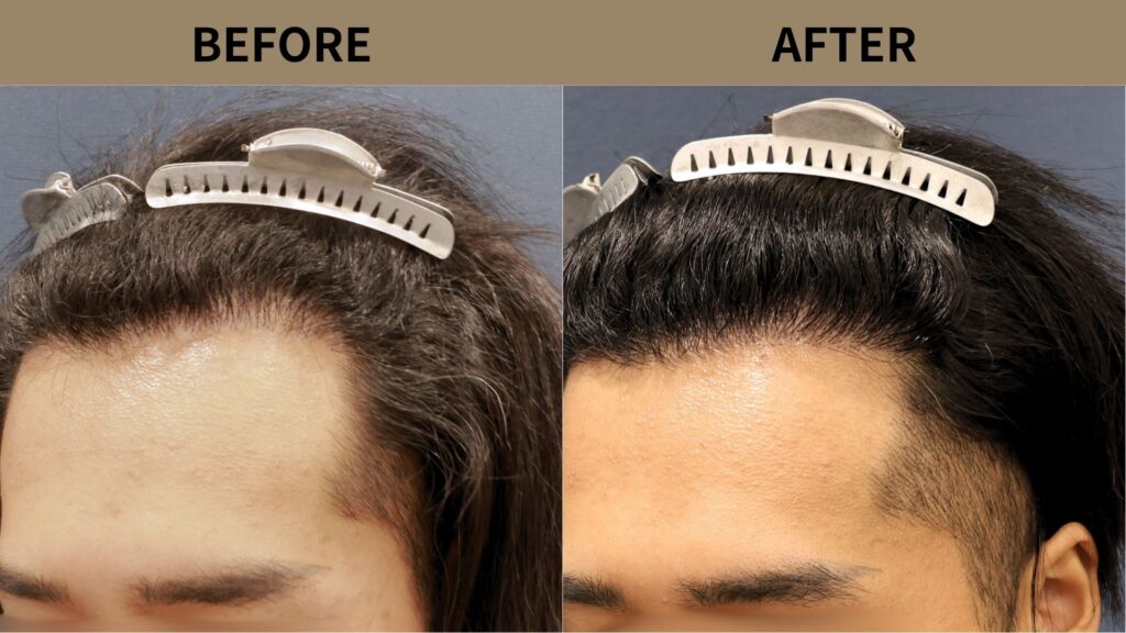 【症例更新】20代男性｜他院修正・生え際の薄毛1200グラフト