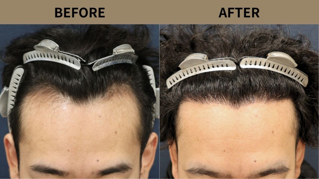 【症例更新】20代男性｜生え際・M字の薄毛