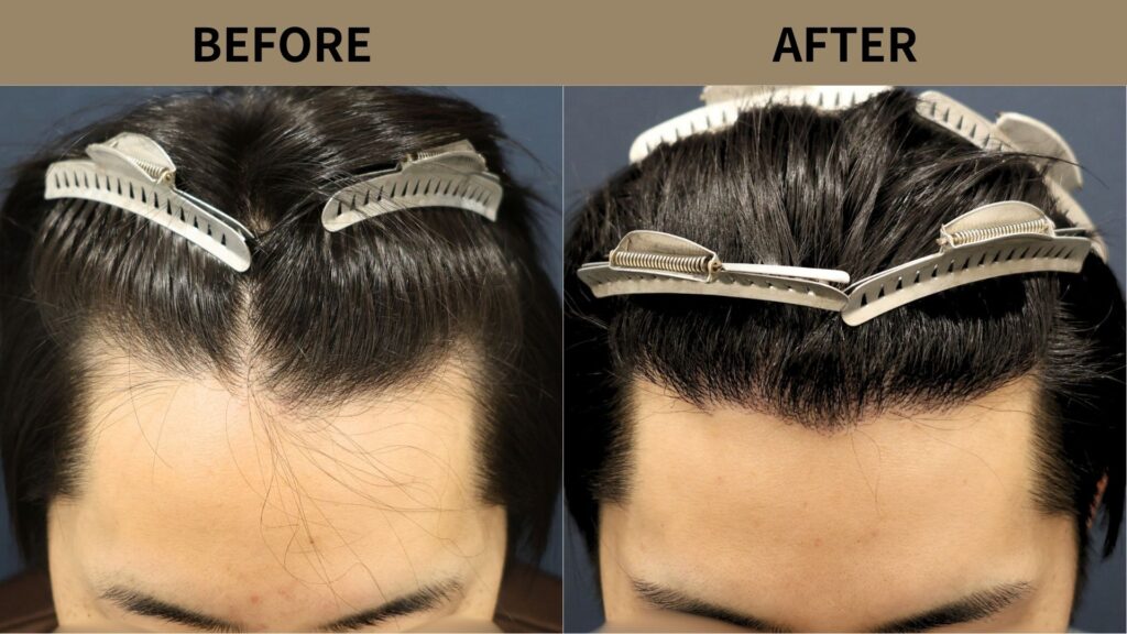 【症例更新】20代男性｜生え際の薄毛1500グラフト