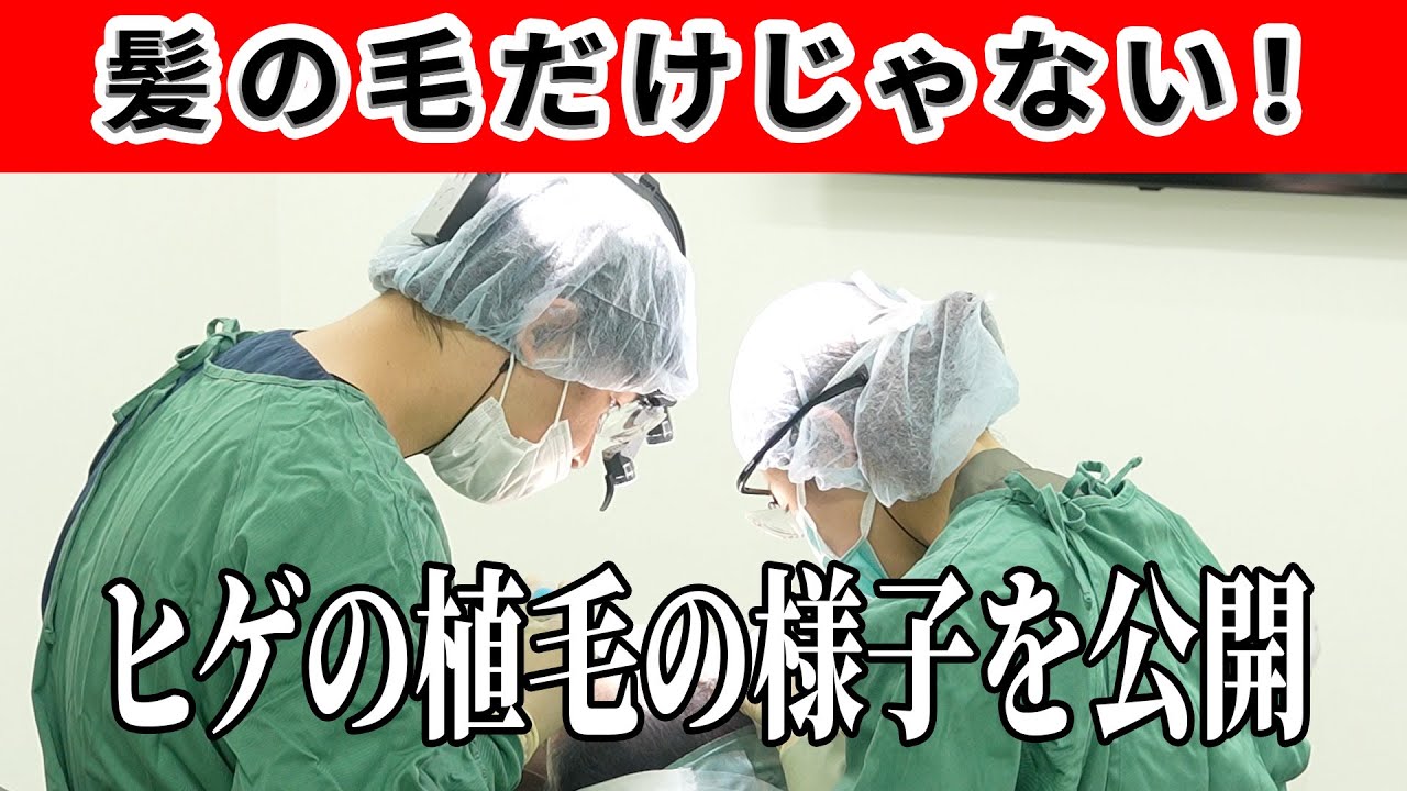 【植毛手術】M字やAGAだけじゃない！ヒゲの植毛手術をお見せします！！