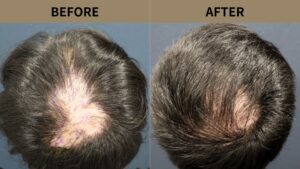 【自毛植毛 症例更新】40代男性｜頭頂部・瘢痕の薄毛1000グラフト