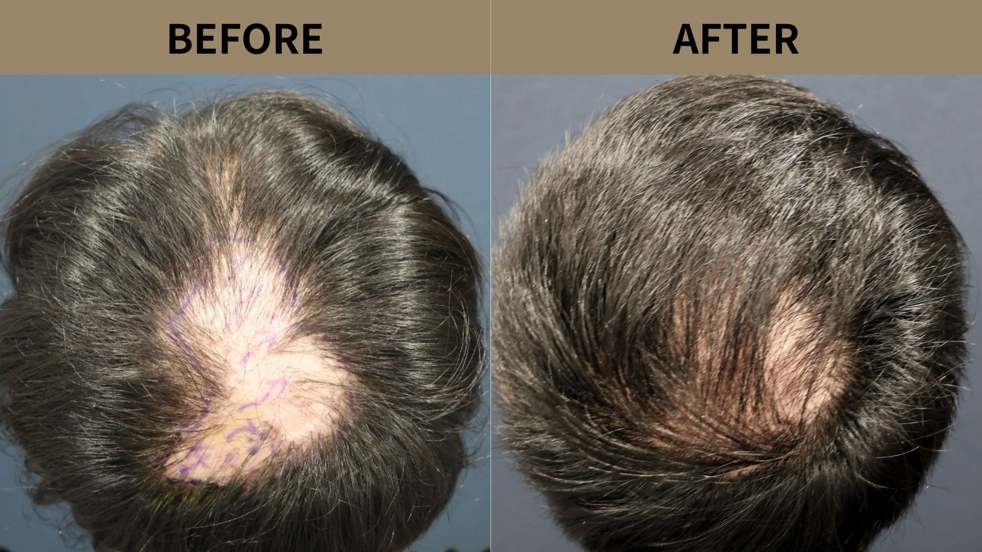 【自毛植毛 症例更新】40代男性｜頭頂部・瘢痕の薄毛1000グラフト