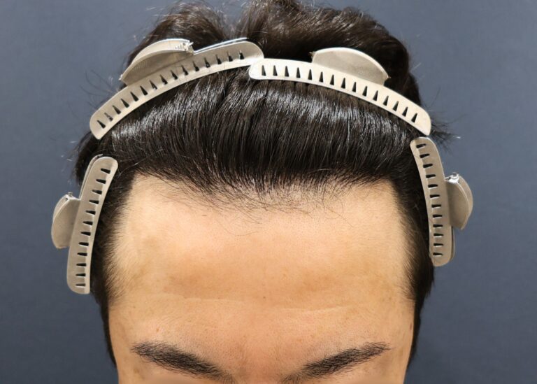 症例写真