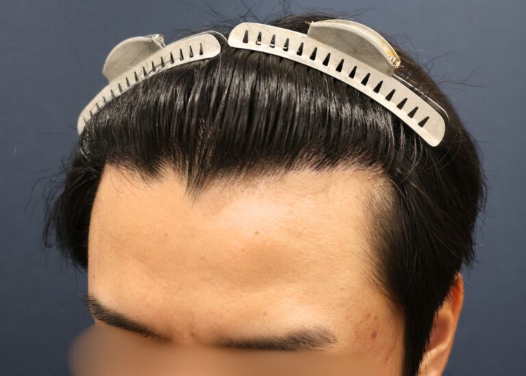 症例写真