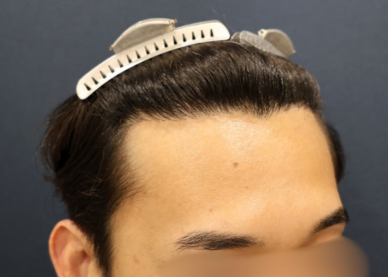 症例写真