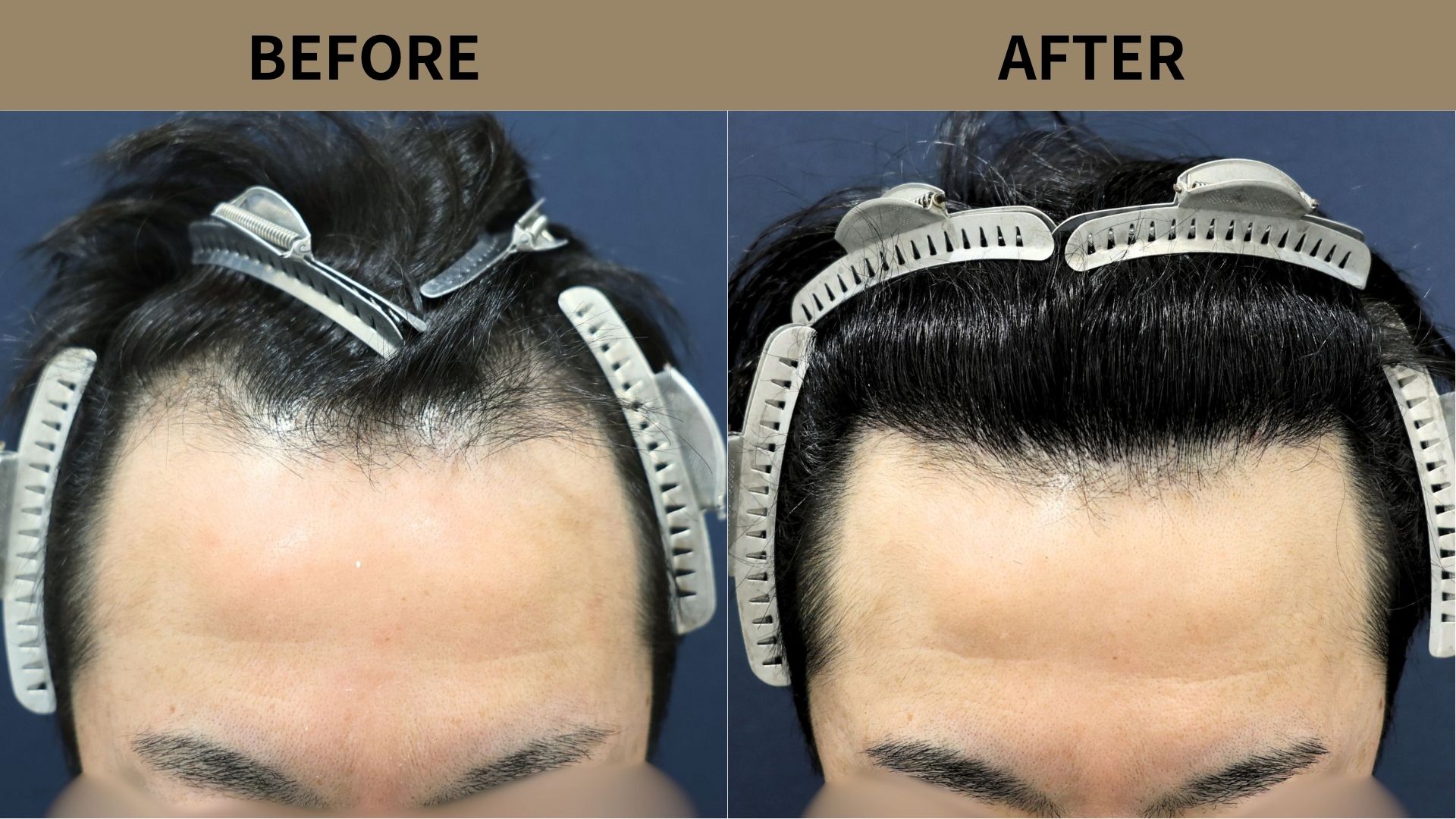 【自毛植毛 症例更新】40代男性｜生え際の薄毛1700グラフト