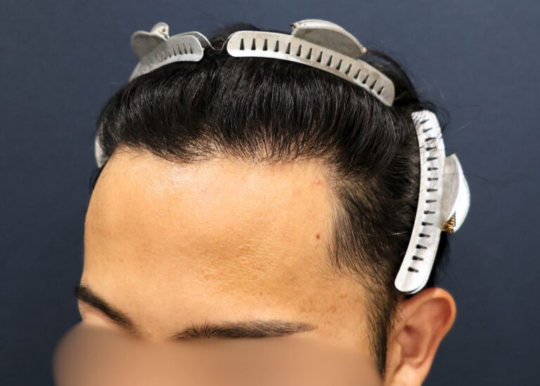 症例写真