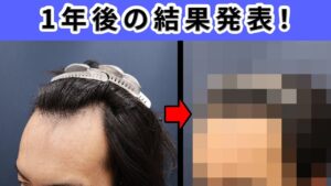 【結果】植毛をして1年が経過！驚きの結果をお見せします