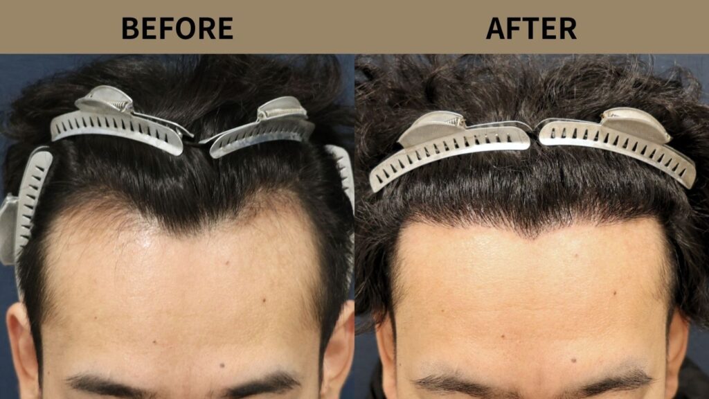 【医師解説】自毛植毛のグラデーションデザインとは？自然な生え際を作る設計思想を解説