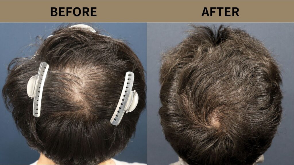 【症例更新】30代男性｜頭頂部の薄毛