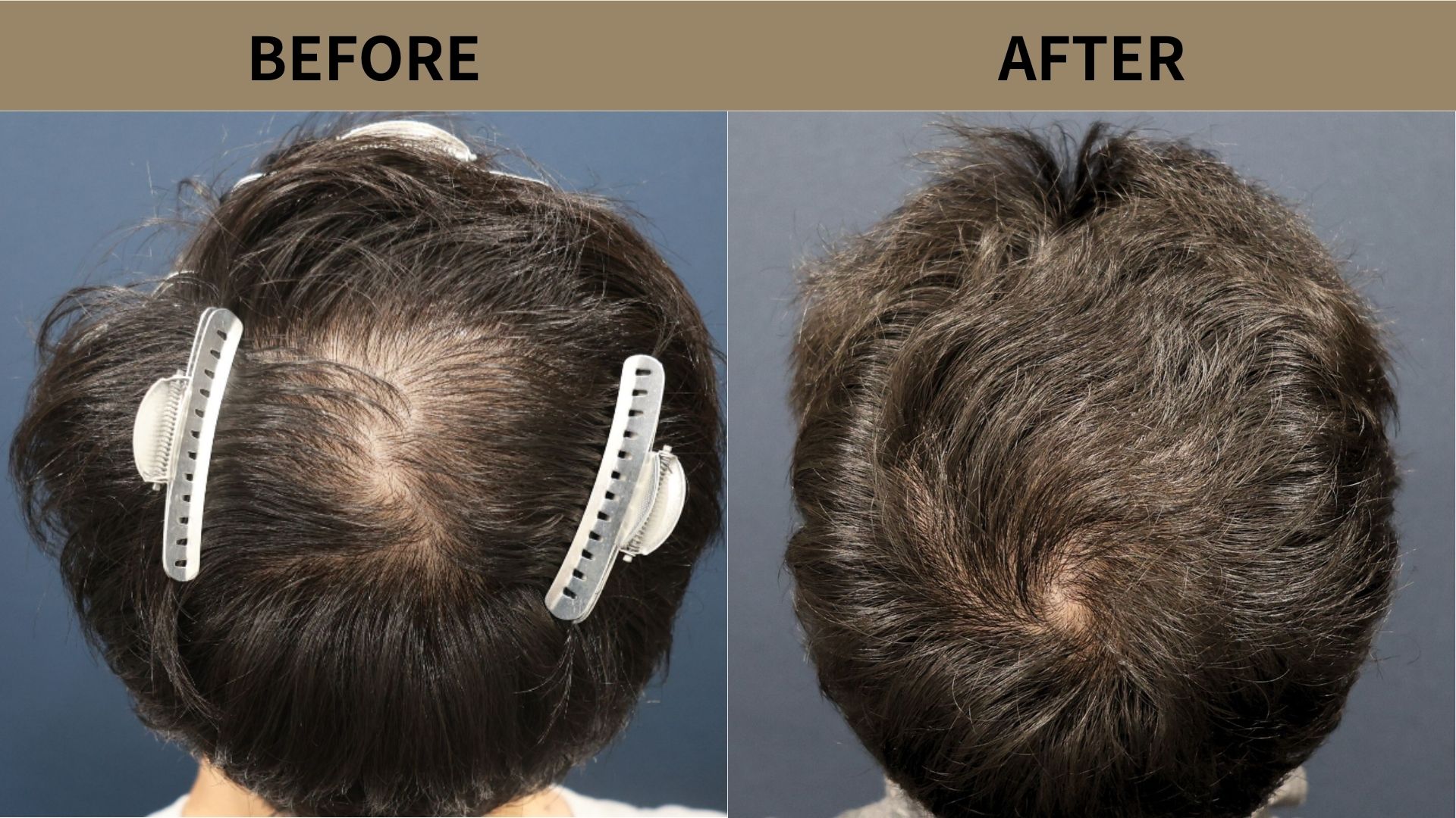 【植毛 症例更新】30代男性｜頭頂部の薄毛400グラフト