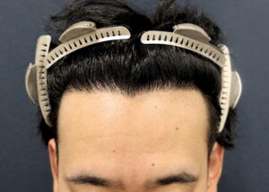 術後1年