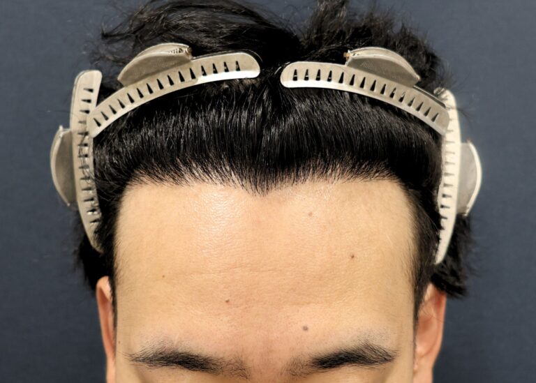 症例写真