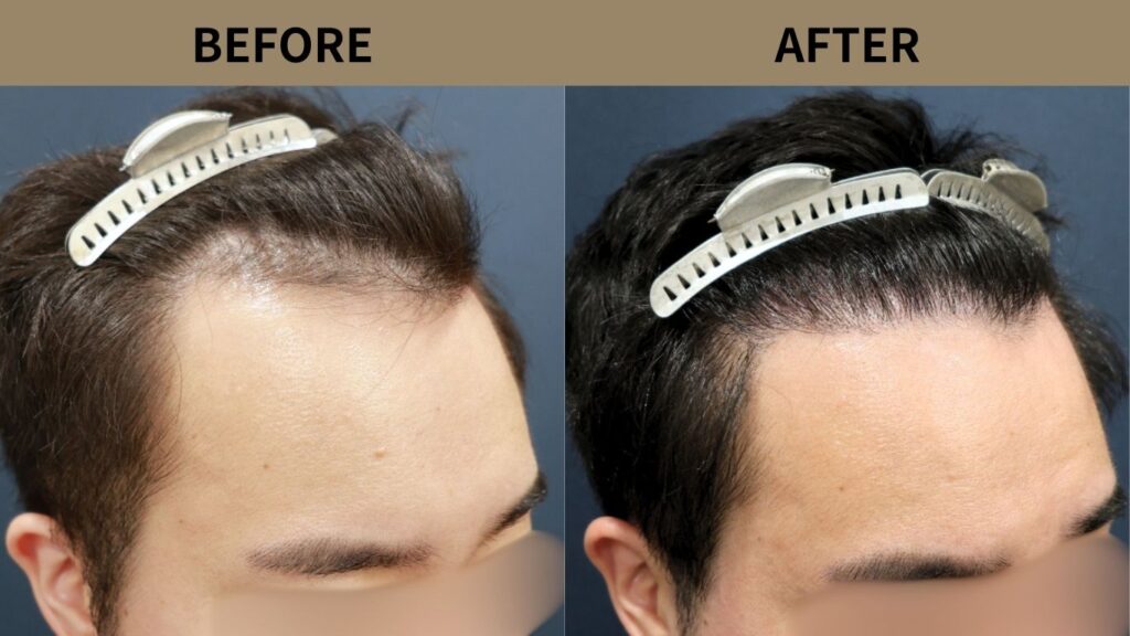 【医師解説】自毛植毛のグラデーションデザインとは？自然な生え際を作る設計思想を解説