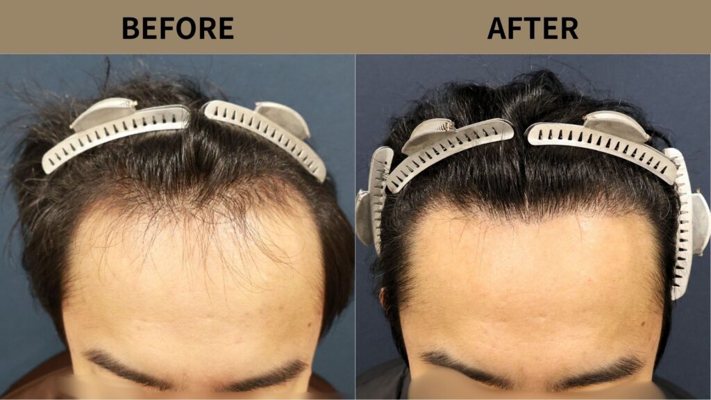 【症例更新】30代男性｜生え際・前頭部の薄毛