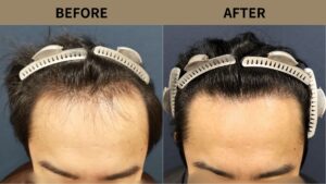 【自毛植毛 症例更新】30代男性｜生え際・前頭部の薄毛1500グラフト