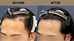 【植毛 症例更新】20代男性｜生え際の薄毛1500グラフト