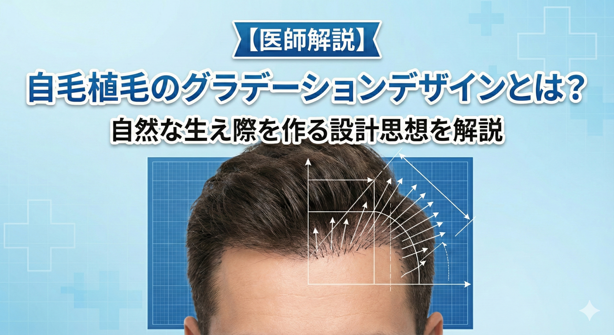 【医師解説】自毛植毛のグラデーションデザインとは？自然な生え際を作る設計思想を解説