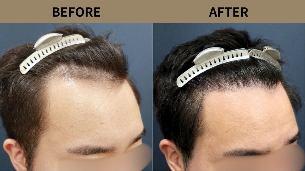 【症例更新】30代男性｜生え際の薄毛