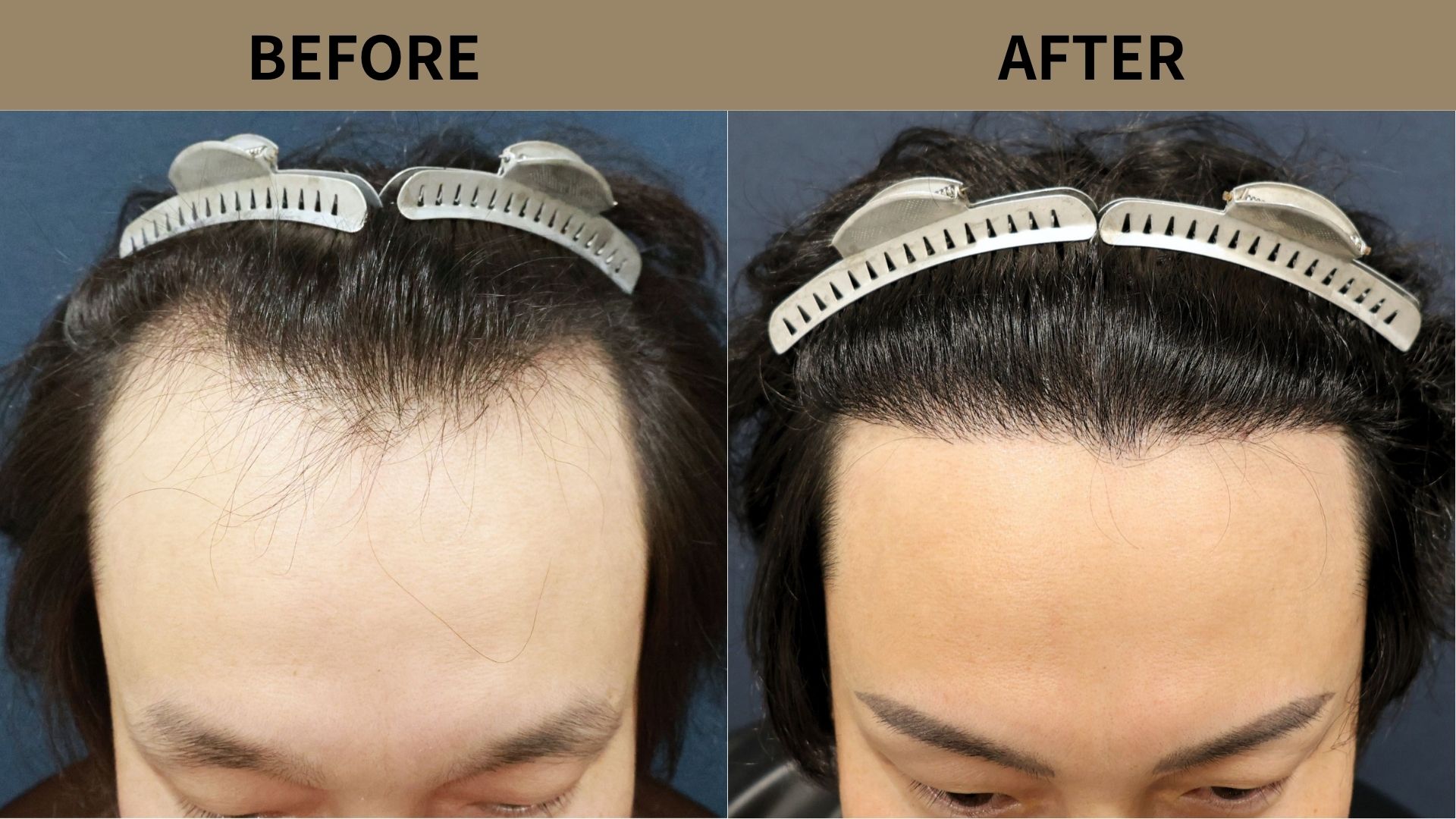 【自毛植毛 症例更新】30代男性｜生え際・前頭部の薄毛2200グラフト