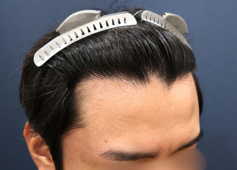 症例写真