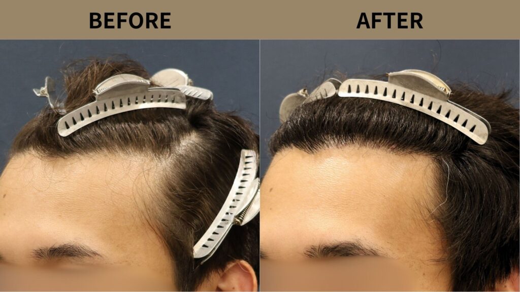 【症例更新】20代男性｜生え際・前頭部の薄毛