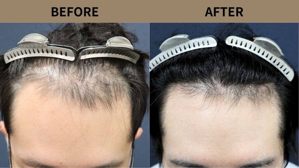 【症例更新】30代男性｜生え際の薄毛・当院2回目800グラフト治療内容：自毛植毛 800グラフト（当院2回目）