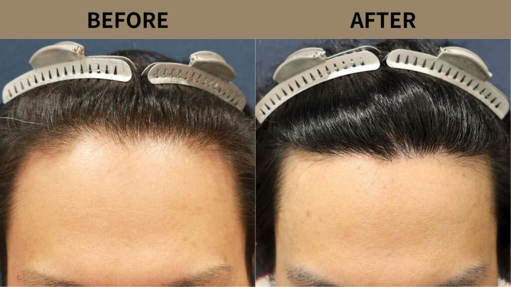 【症例更新】40代男性｜生え際の薄毛・密度アップ1400グラフト