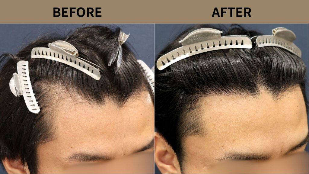 【症例更新】20代男性｜生え際の薄毛1200グラフト