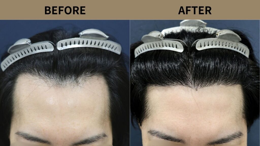 【医師解説】自毛植毛のグラデーションデザインとは？自然な生え際を作る設計思想を解説