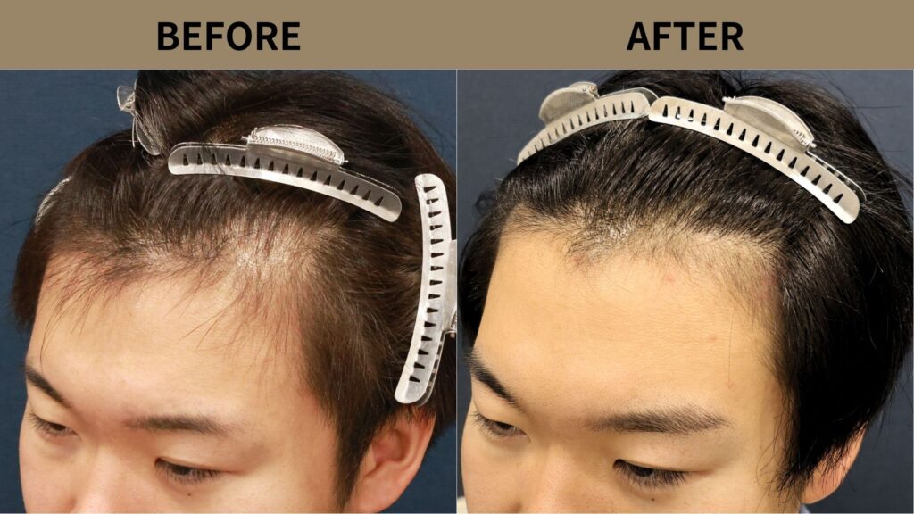 【症例更新】20代男性｜生え際・M字の薄毛1000グラフト
