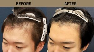 【自毛植毛 症例更新】20代男性｜生え際・M字の薄毛1000グラフト