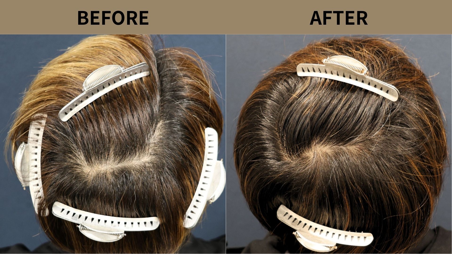 【症例更新】30代男性｜頭頂部の薄毛1200グラフト