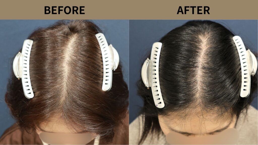 【植毛 症例更新】40代女性｜女性に多い「分け目」の薄毛・他院修正1500グラフト