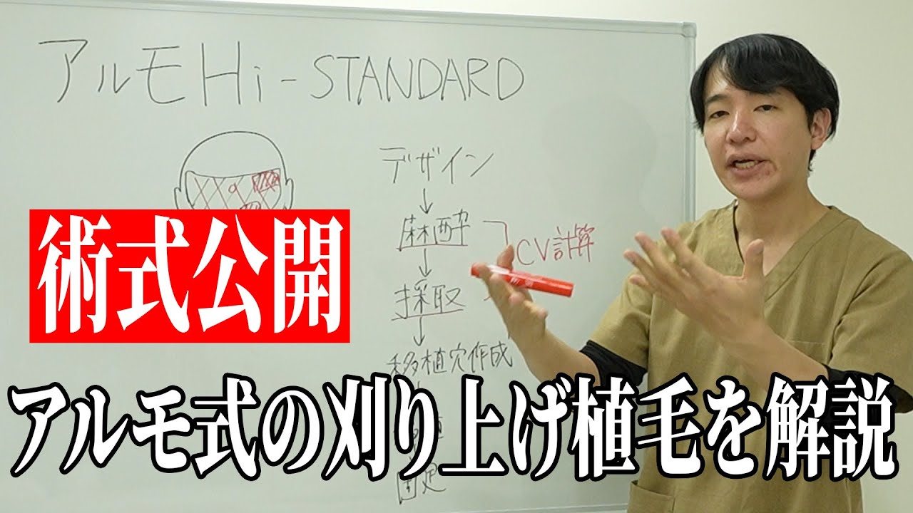 【刈り上げ植毛】アルモ式の刈り上げる植毛を丁寧に解説していきます！