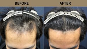 【植毛 症例更新】30代男性｜生え際の薄毛・当院2回目1000グラフト