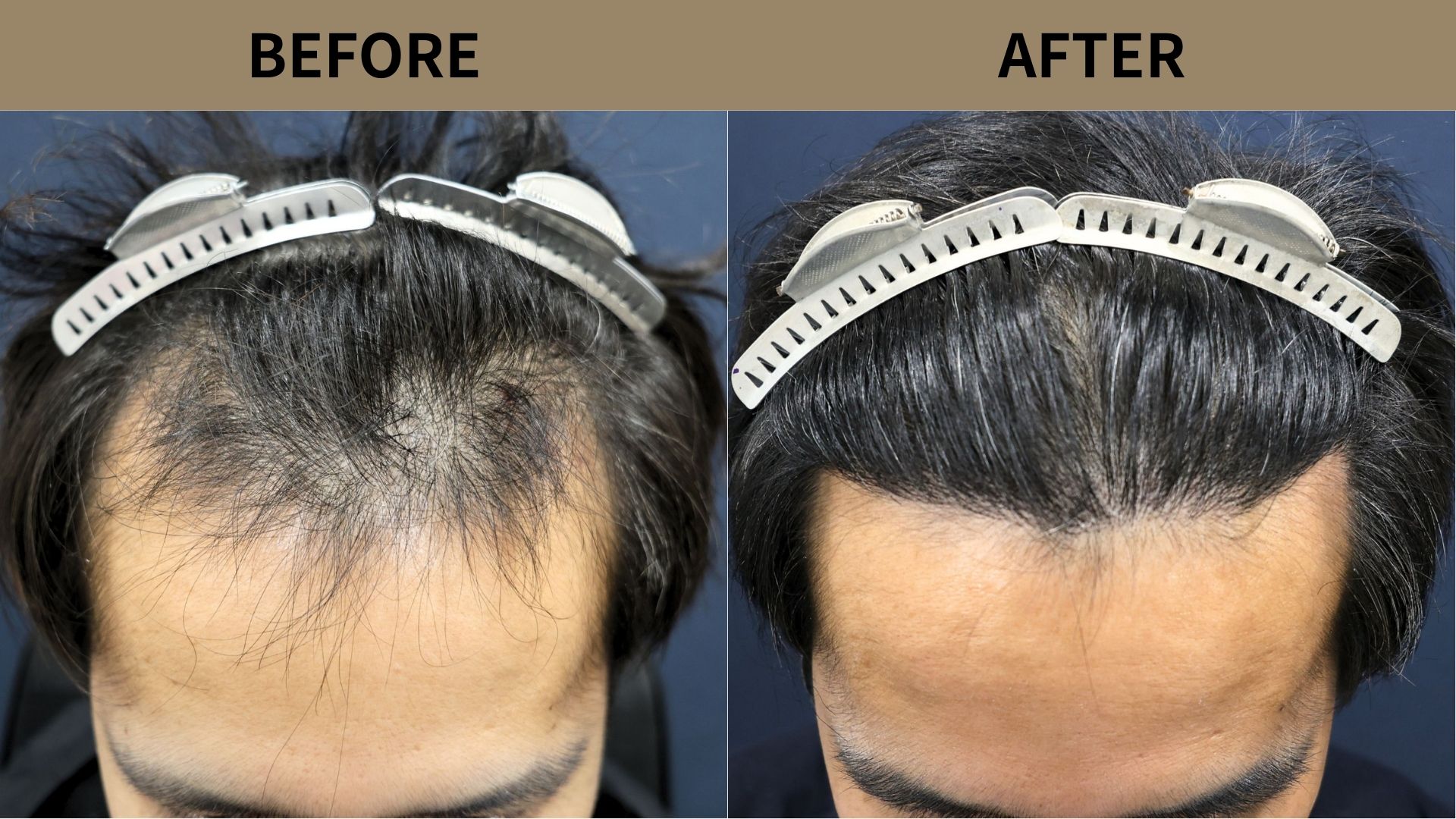 【植毛 症例更新】30代男性｜生え際の薄毛・当院2回目1000グラフト