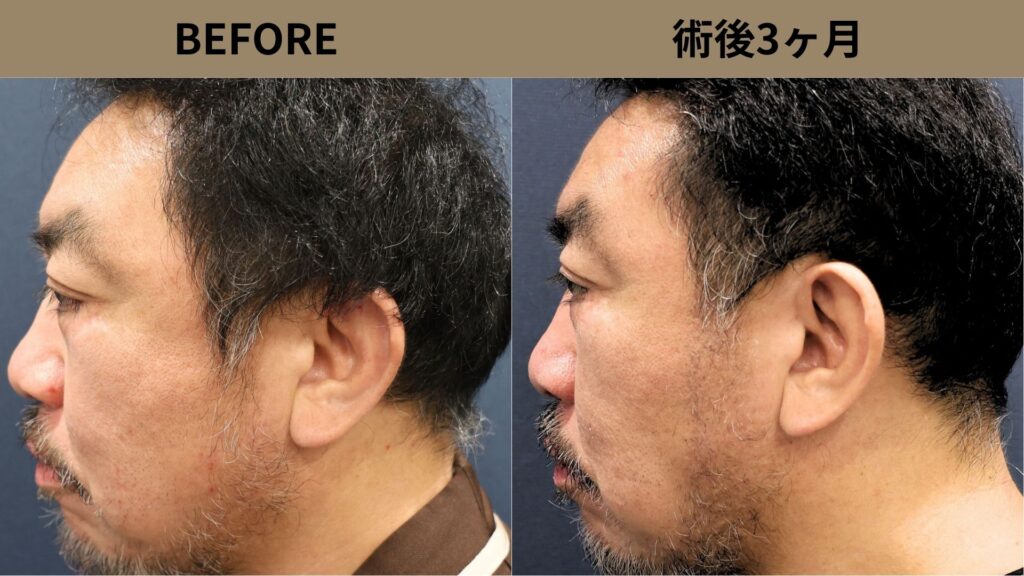 【植毛 症例更新】50代男性｜ヒゲ植毛・他院修正800グラフト