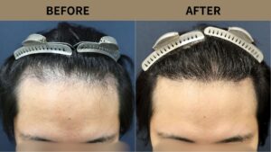 【自毛植毛 症例更新】20代男性｜生え際の薄毛1500グラフト