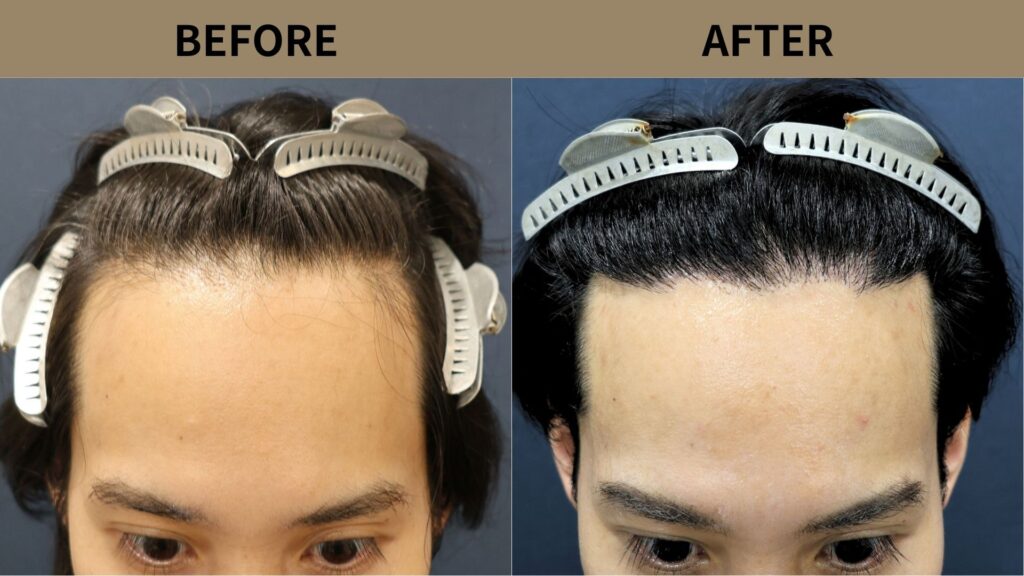 【植毛 症例更新】30代男性｜生え際の薄毛1500グラフト