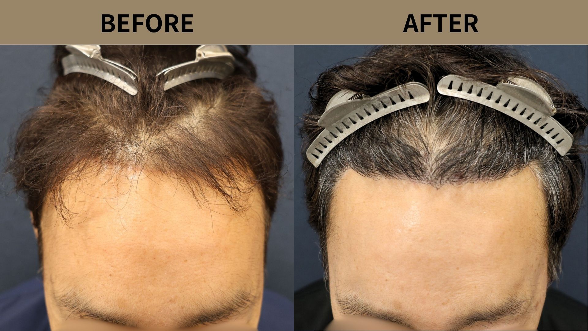 【植毛 症例更新】60代男性｜前額リフト傷跡修正・生え際密度アップ1600グラフト